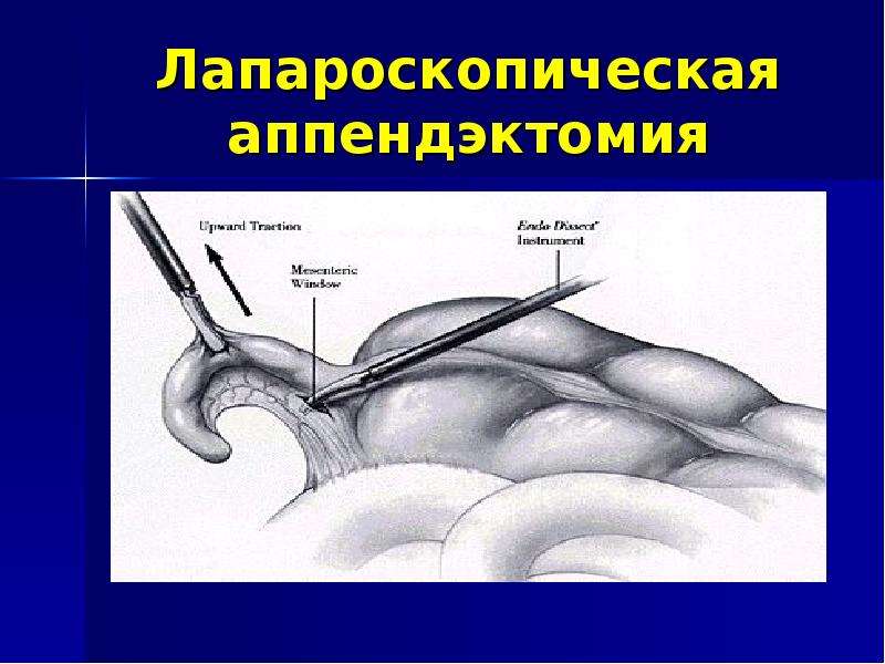Лапароскопическая Аппендэктомия Диета После Операции