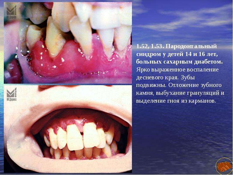Заболевания молочных зубов