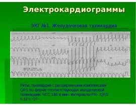 Электрокардиограммы  ЭКГ №1. Желудочковая тахикардия   Ритм: тахикардия с расширенными комплексами QRS по форме соответствующая жел