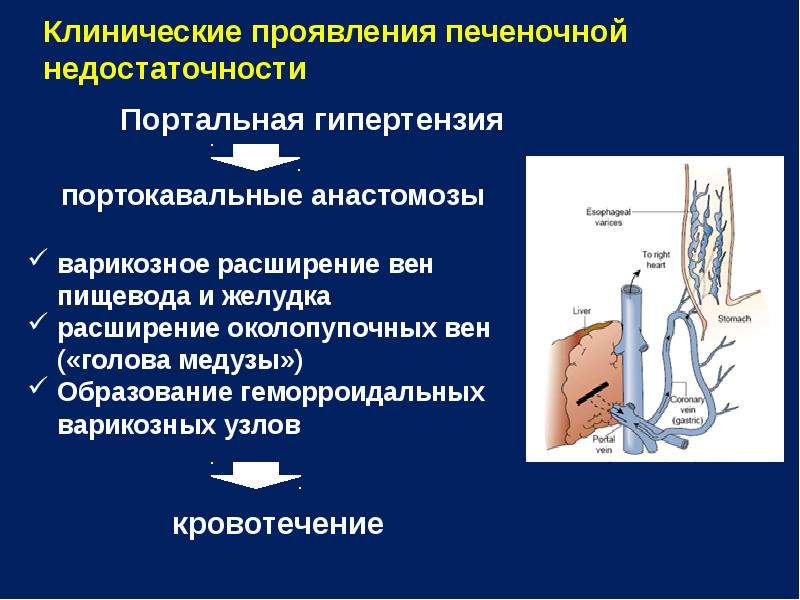 Варикозное Расширение Вен В Желудке