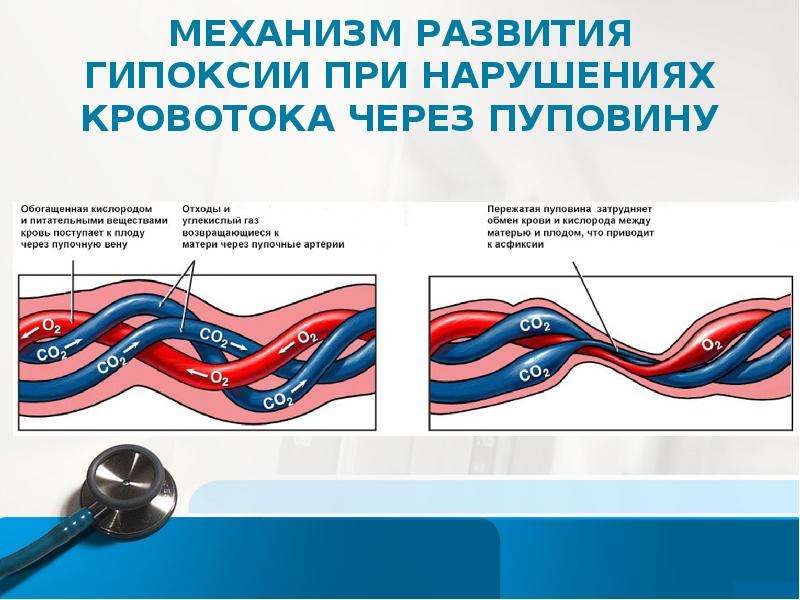 2 Вены В Пуповине Вместо 3