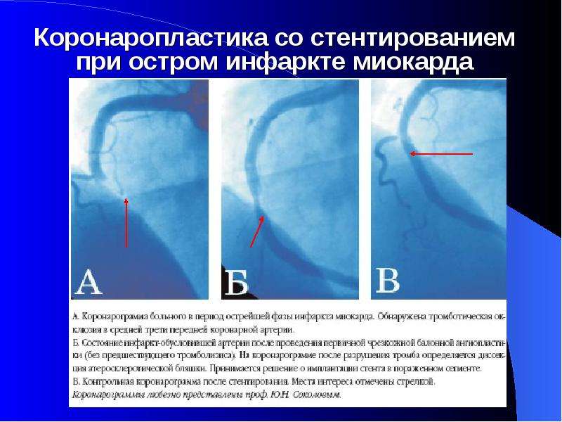  Коронаропластика со стентированием при остром инфаркте миокарда
