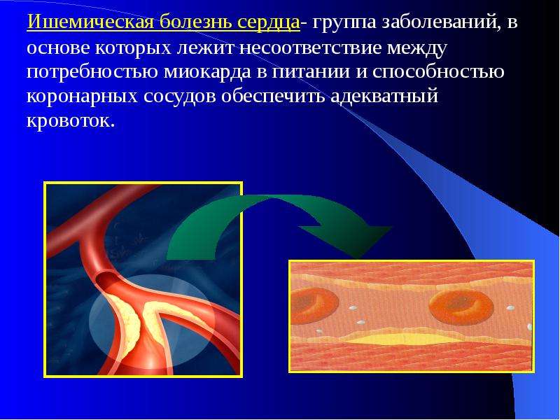   Ишемическая болезнь сердца- группа заболеваний, в основе которых лежит несоответствие между потребностью миокарда в питании и способностью коронарных сосудов обеспечить адекватный кровоток.
 Ишемическая болезнь сердца- группа заболеваний, в основе которых лежит несоответствие между потребностью миокарда в питании и способностью коронарных сосудов обеспечить адекватный кровоток.
