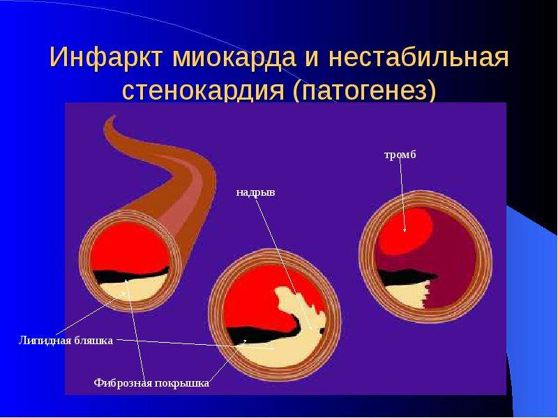   Инфаркт миокарда и нестабильная стенокардия (патогенез)

