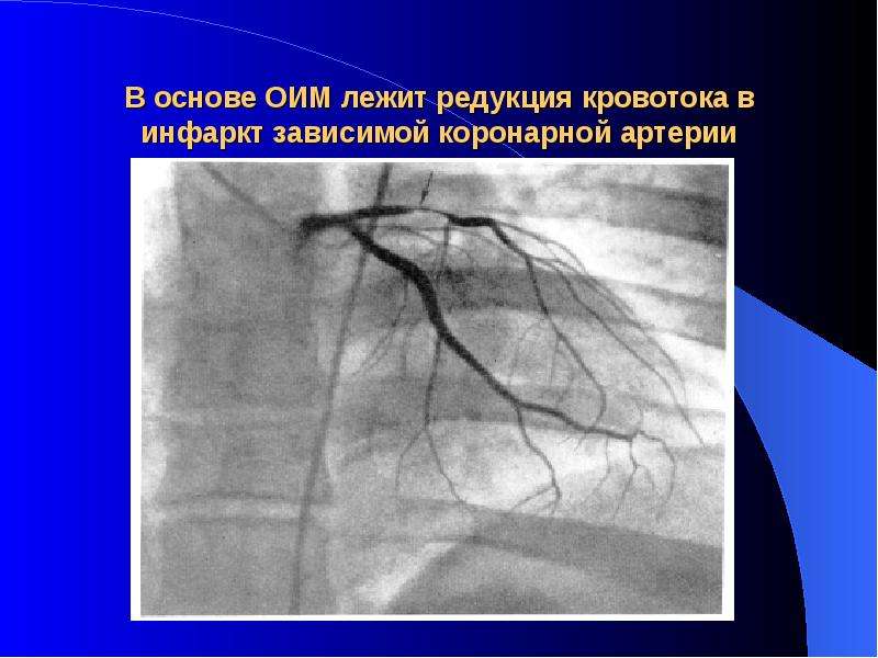   В основе ОИМ лежит редукция кровотока в инфаркт зависимой коронарной артерии
