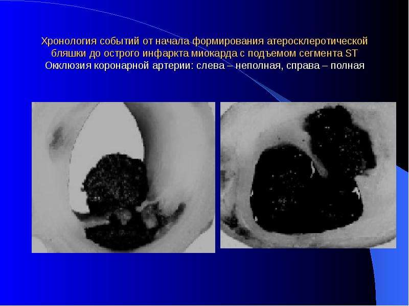   Хронология событий от начала формирования атеросклеротической бляшки до острого инфаркта миокарда с подъемом сегмента ST
Окклюзия коронарной артерии: слева – неполная, справа – полная
