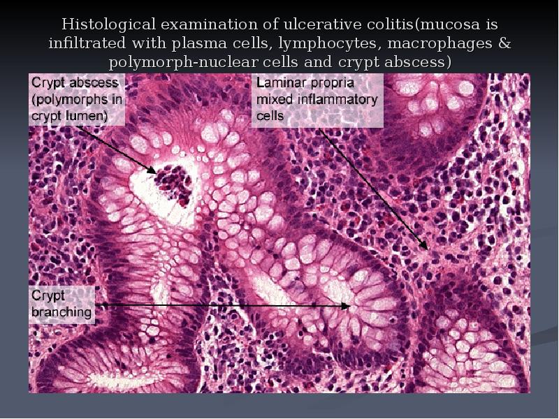   Histological examination of ulcerative colitis(mucosa is infiltrated with plasma cells, lymphocytes, macrophages & polymorph-nuclear cells and crypt abscess)
