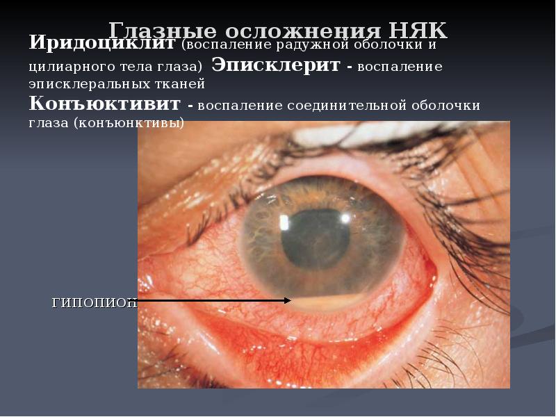  Глазные осложнения НЯК
гипопион
