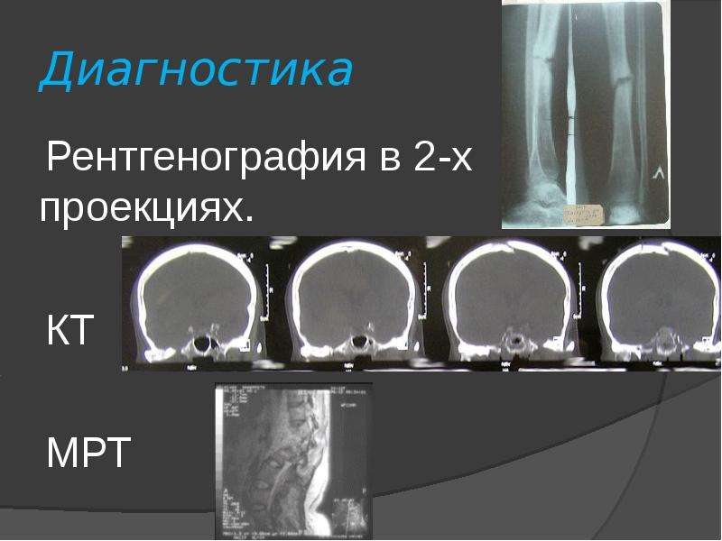   Диагностика
 Рентгенография в 2-х проекциях.
 КТ 
 МРТ
