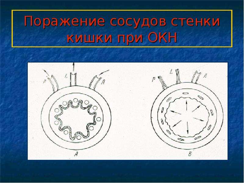   Поражение сосудов стенки кишки при ОКН
