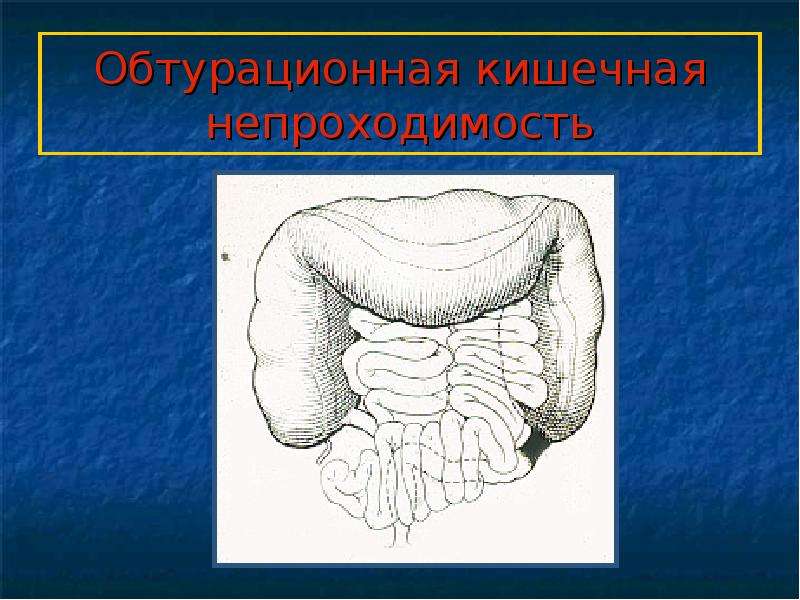   Обтурационная кишечная непроходимость
