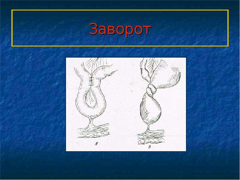   Заворот
