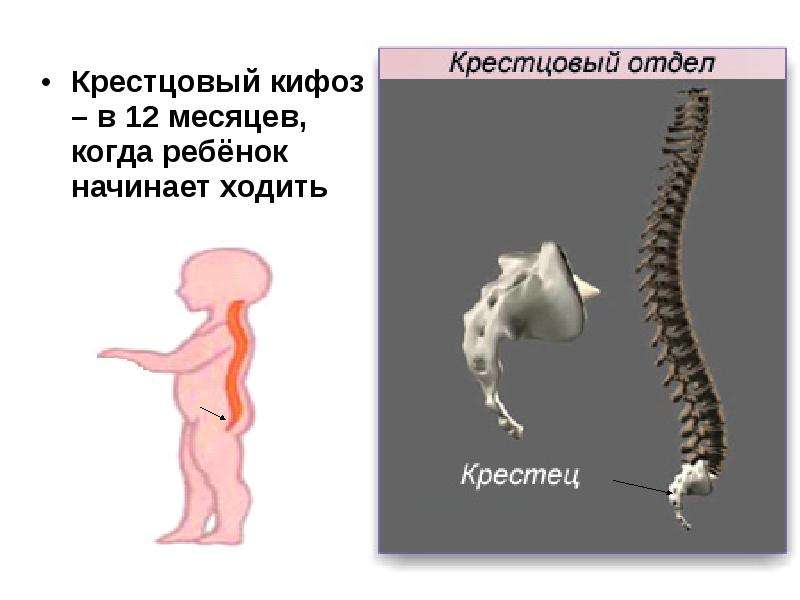   Крестцовый кифоз – в 12 месяцев, когда ребёнок начинает ходить
Крестцовый кифоз – в 12 месяцев, когда ребёнок начинает ходить  