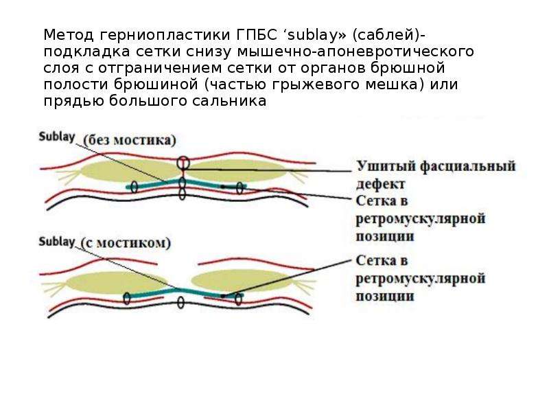   Метод герниопластики ГПБС ‘sublay» (саблей)- подкладка сетки снизу мышечно-апоневротического слоя с отграничением сетки от органов брюшной полости брюшиной (частью грыжевого мешка) или прядью большого сальника
