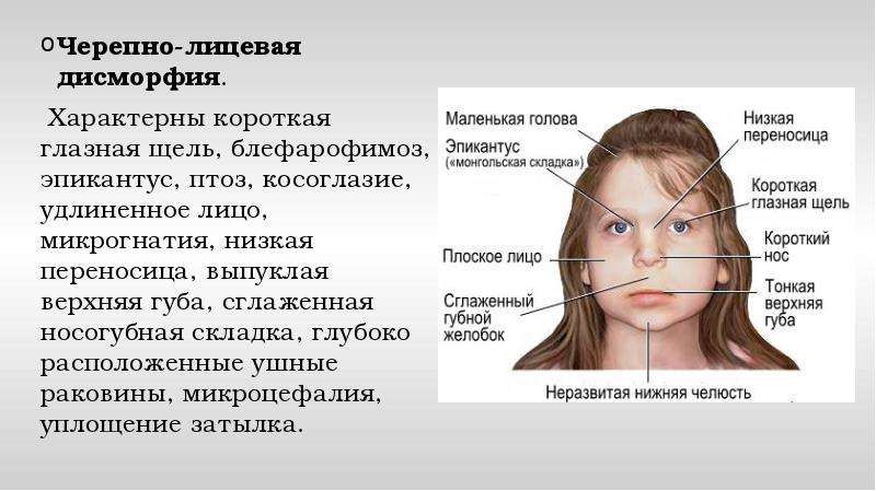  
Черепно-лицевая дисморфия.
 Характерны короткая глазная щель, блефарофимоз, эпикантус, птоз, косоглазие, удлиненное лицо, микрогнатия, низкая переносица, выпуклая верхняя губа, сглаженная носогубная складка, глубоко расположенные ушные раковины, микроцефалия, уплощение затылка.
