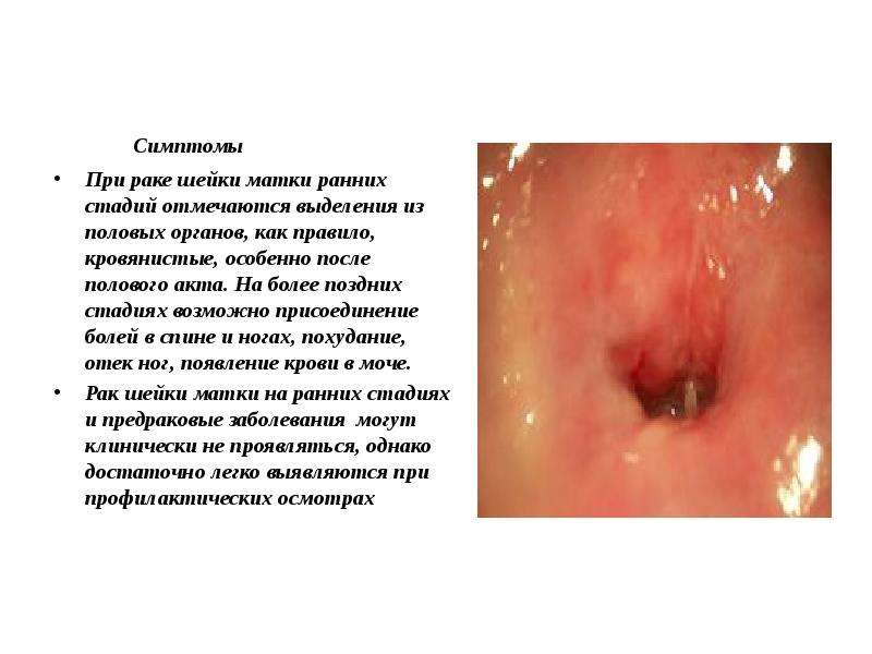   Симптомы
 Симптомы
При раке шейки матки ранних стадий отмечаются выделения из половых органов, как правило, кровянистые, особенно после полового акта. На более поздних стадиях возможно присоединение болей в спине и ногах, похудание, отек ног, появление крови в моче.
Рак шейки матки на ранних стадиях и предраковые заболевания  могут клинически не проявляться, однако достаточно легко выявляются при профилактических осмотрах
