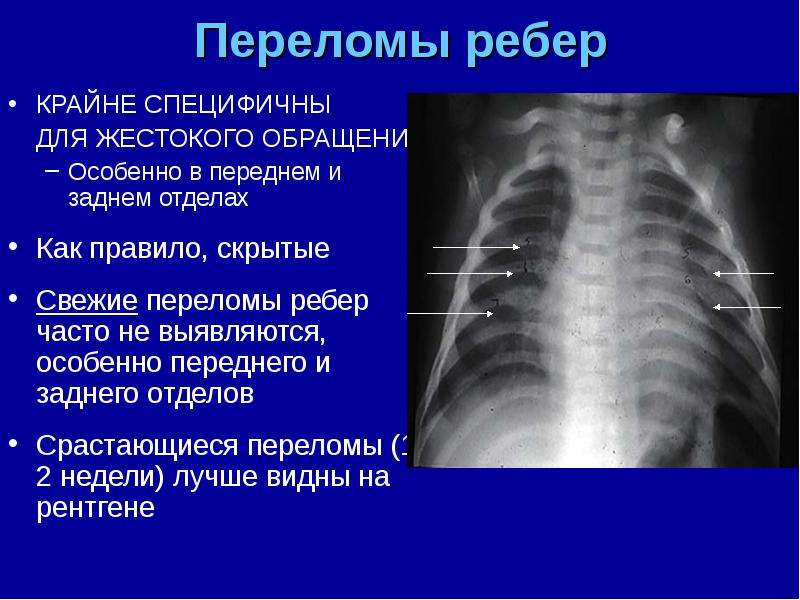 Симптомы трещины в ребре