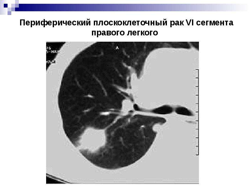 Периферический рак правого. Плоскоклеточная карцинома кт. Периферический образование правого лёгкого прогноз.