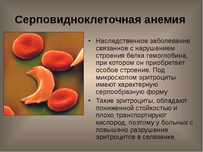 Эритроциты что это. Гемоглобин серповидноклеточная анемия. Серповидноклеточная анемия плейотропия. Серповидноклеточная анемия эритроциты. Серповидная анемия мутация.