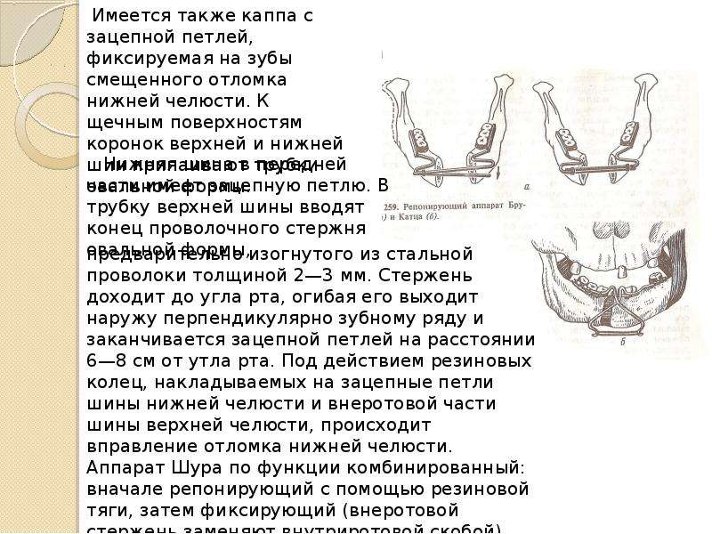 Методы временной и постоянной иммобилизации отломков челюстей презентация