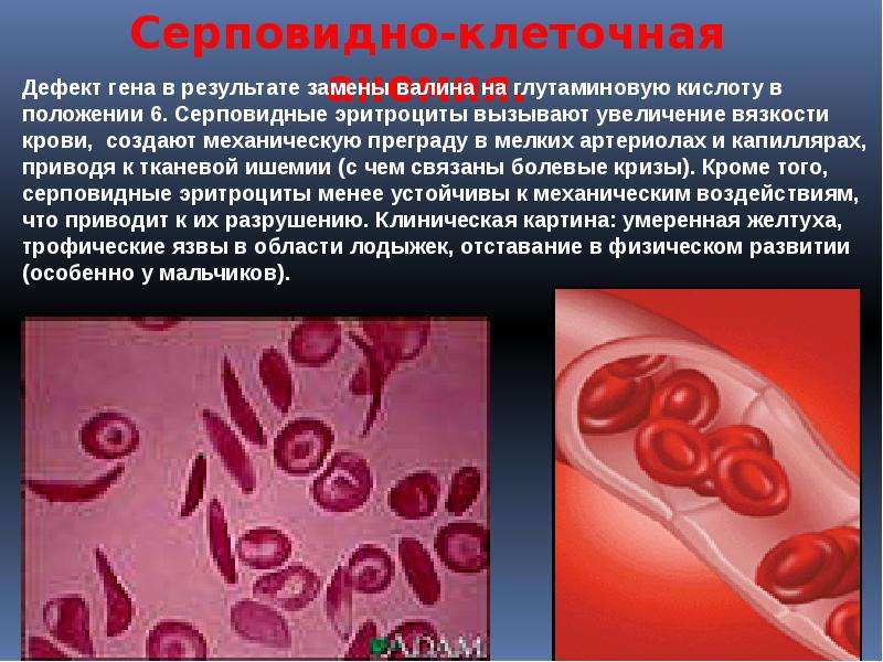 Дефектный ген что это такое. Серповидноклеточная анемия генная. Серповидноклеточная анемия показатели крови. Серповидноклеточная анемия эритроциты. Серповидноклеточная анемия Валин.