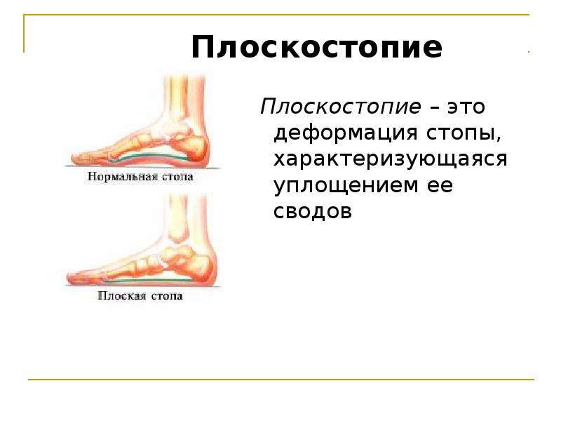 Причины плоскостопия. Плоскостопие презентация. Плоскостопие это кратко. Плоскостопияпрезинтатсия. Сообщение о плоскостопии.