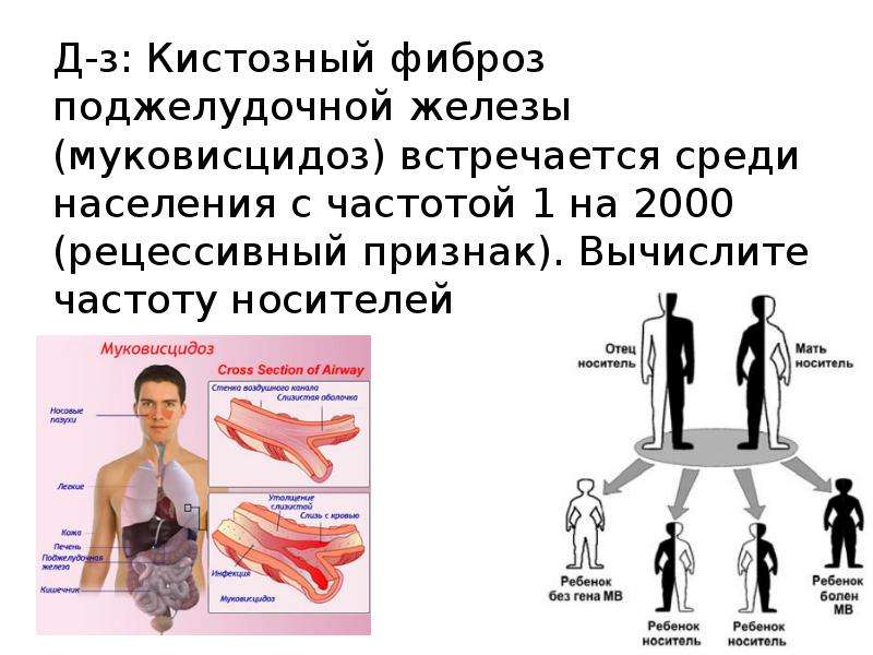 Муковисцидоз презентация по генетике