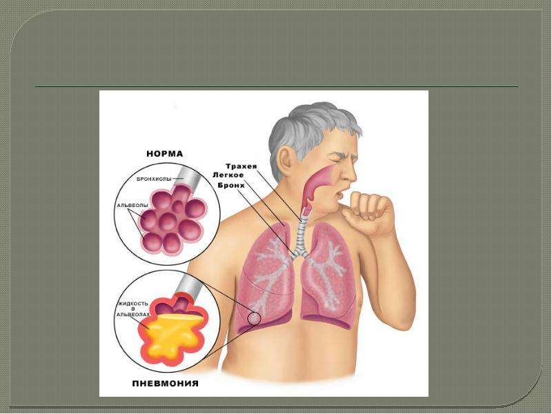 Картинки на тему пневмония