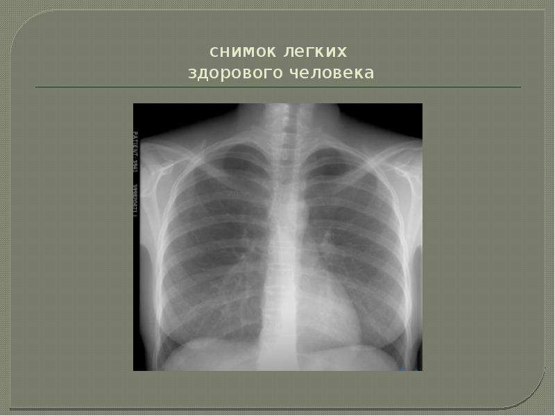 Рентген шейного отдела здорового человека фото