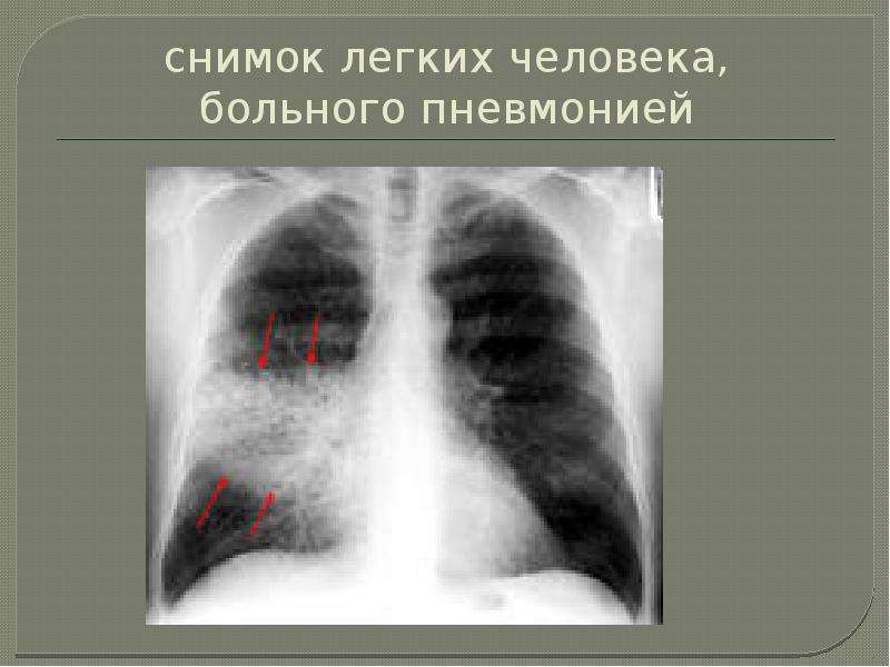 Фото здоровых легких и легких при пневмонии