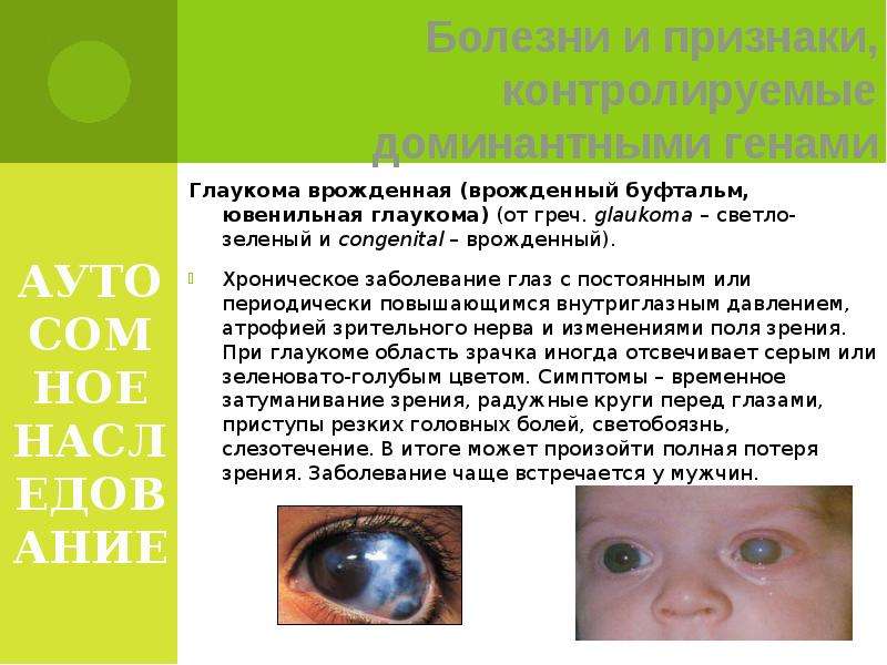 АУТОСОМНОЕ НАСЛЕДОВАНИЕ Глаукома врожденная (врожденный буфтальм, ювенильная глаукома) (от греч. gla