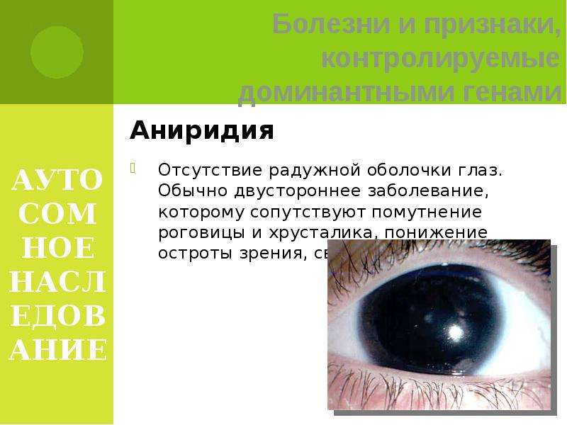 АУТОСОМНОЕ НАСЛЕДОВАНИЕ Аниридия Отсутствие радужной оболочки глаз. Обычно двустороннее заболевание,