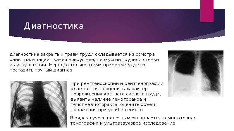 Закрытая травма легкого. Признак повреждения легкого при закрытой травме груди. Травма легкого симптомы. Гематома на рентгене грудной клетки.