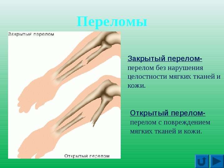 Презентация на тему: Первая помощь при повреждениях скелета, слайд №5