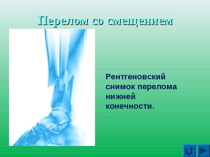 Презентация на тему: Первая помощь при повреждениях скелета, слайд №6