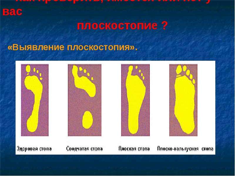 Выявление плоскостопия. Выявление плоскостопи. Методы выявления плоскостопия. Выявление плоскостопия вывод.