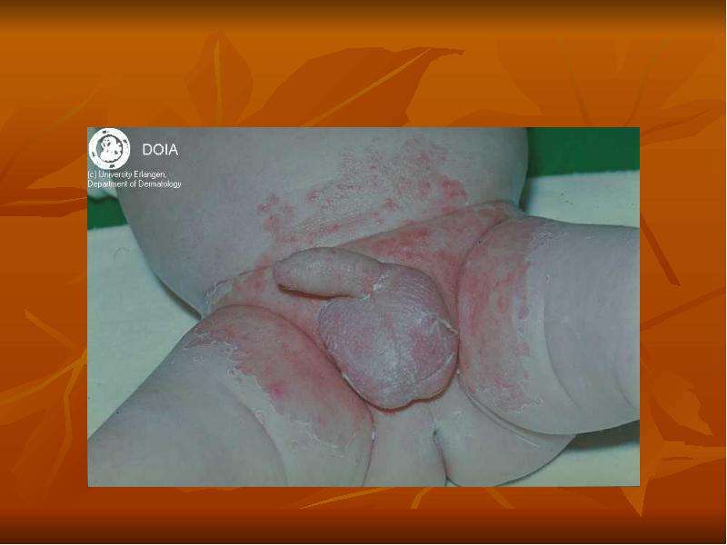 Заболевания кожи в период новорожденности, слайд 16