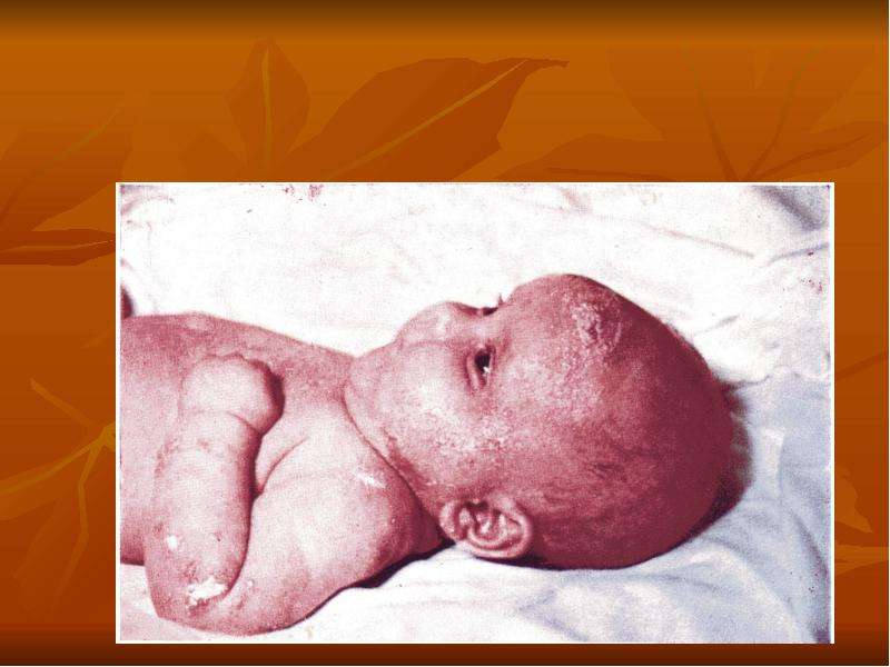 Заболевания кожи в период новорожденности, слайд 20
