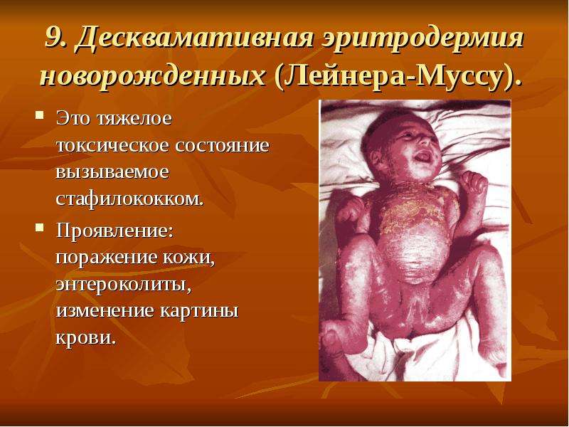 9. Десквамативная эритродермия новорожденных (Лейнера-Муссу). Это тяжелое токсическое состояние вызы