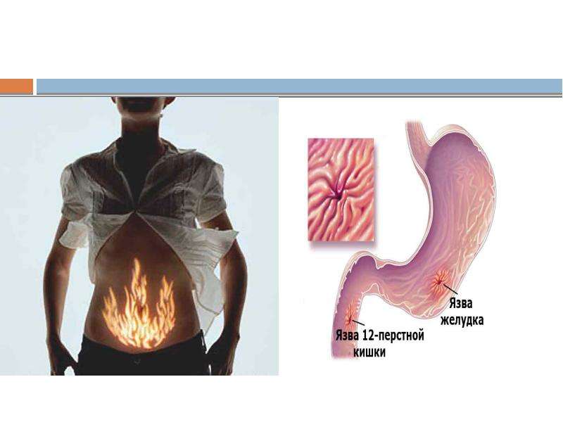Язвенная болезнь двенадцатиперстной кишки картинки