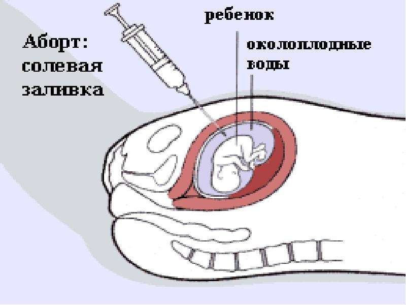 Схема прерывания беременности