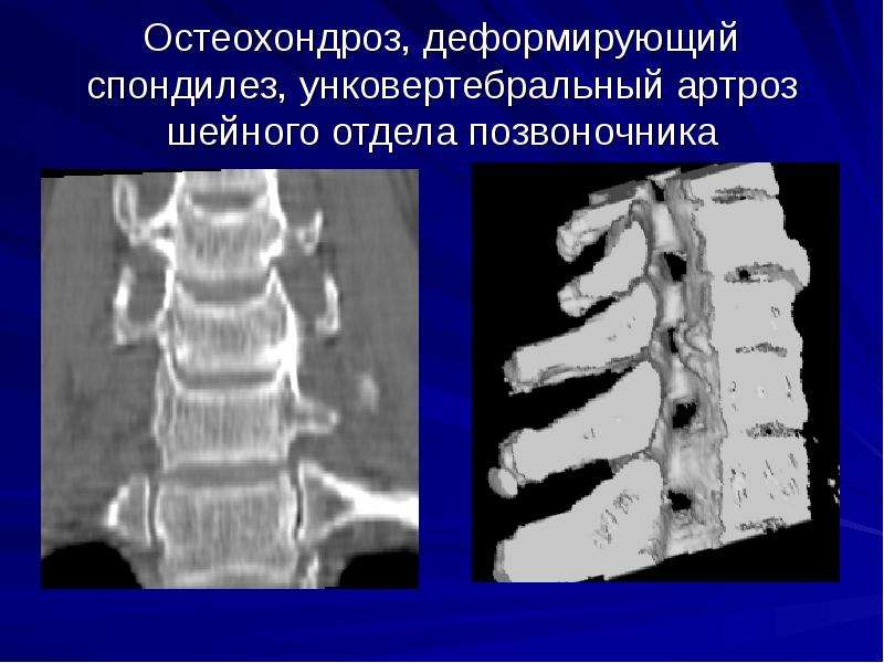 Компьютерная томография позвоночника как проводится видео