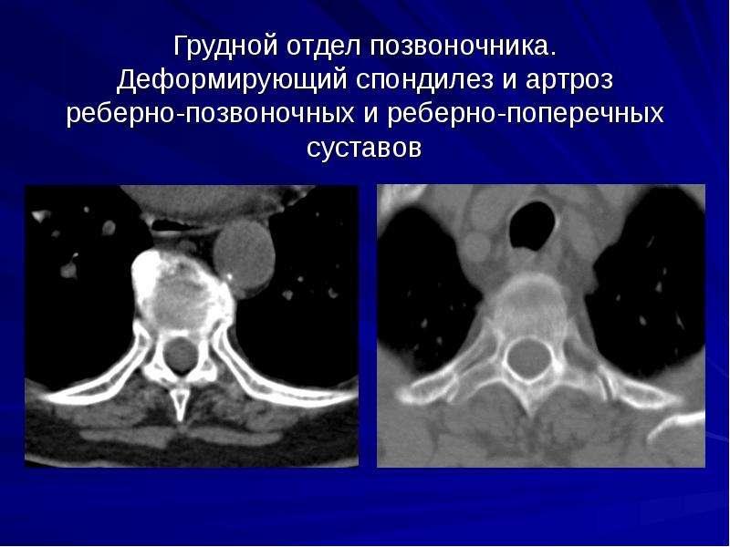 Компьютерная томография позвоночника как проводится видео