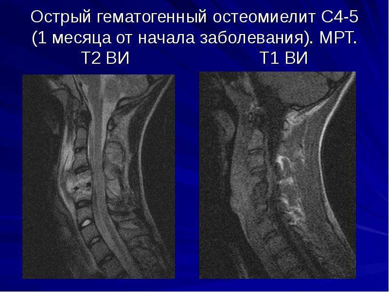 Компьютерная томография позвоночника как проводится видео