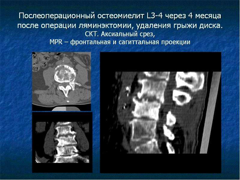 Компьютерная томография позвоночника как проводится видео