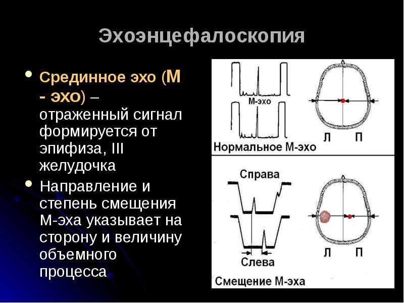 М эх. Эхоэнцефалоскопия. Эхоэнцефалоскопия расшифровка результатов таблица. Срединное м Эхо. Ширина м Эхо норма головного.