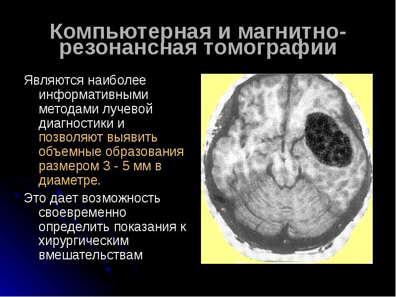 Опухоль головного мозга презентация