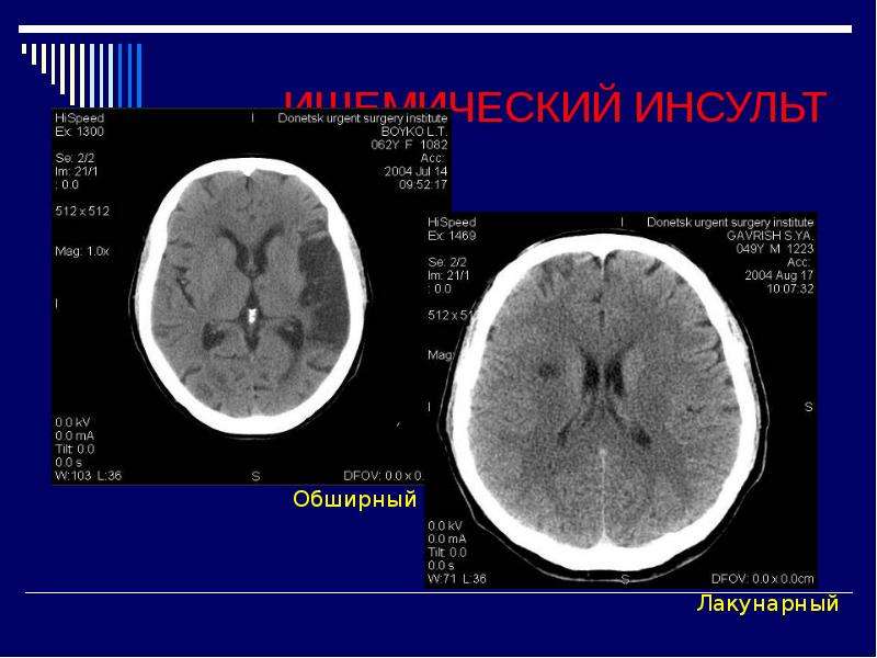 Язык при инсульте фото