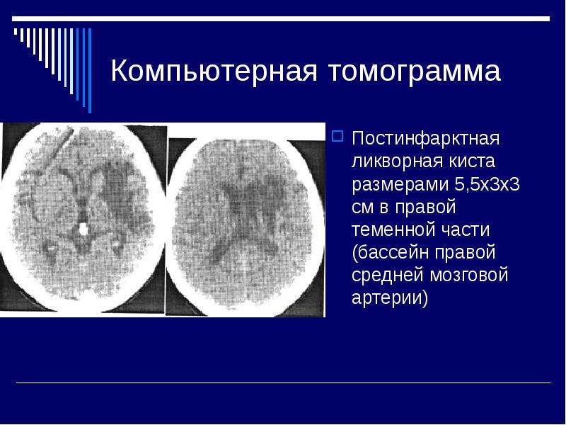 Ликворная киста головного