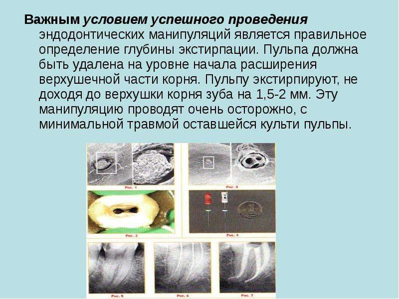 Повторное эндодонтическое лечение презентация